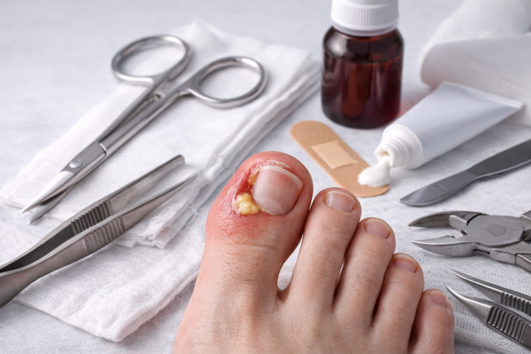 Unghia incarnita: quando operare, come farla spurgare e costo dell’intervento