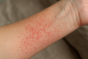 Falsa scabbia: cause, sintomi, diagnosi differenziale, trattamento