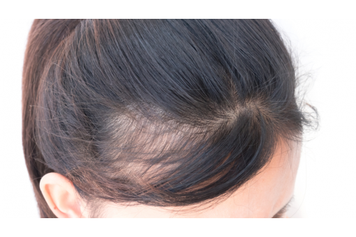 Quando si tratta di alopecia da stress